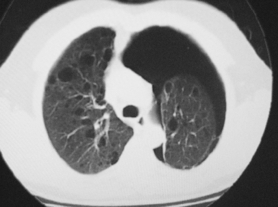 HRCT plic – oboustranný bulózní emfyzém, levostranný PNO
Fig. 3. HRCT lung scan – bilateral bullate emphysema, left – sided PNO