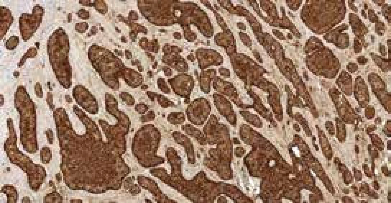 a. Histological section: Solid, insular masses
of monotonous small round cells positive
for chromogranin, immunohistochemical
staining, 200×