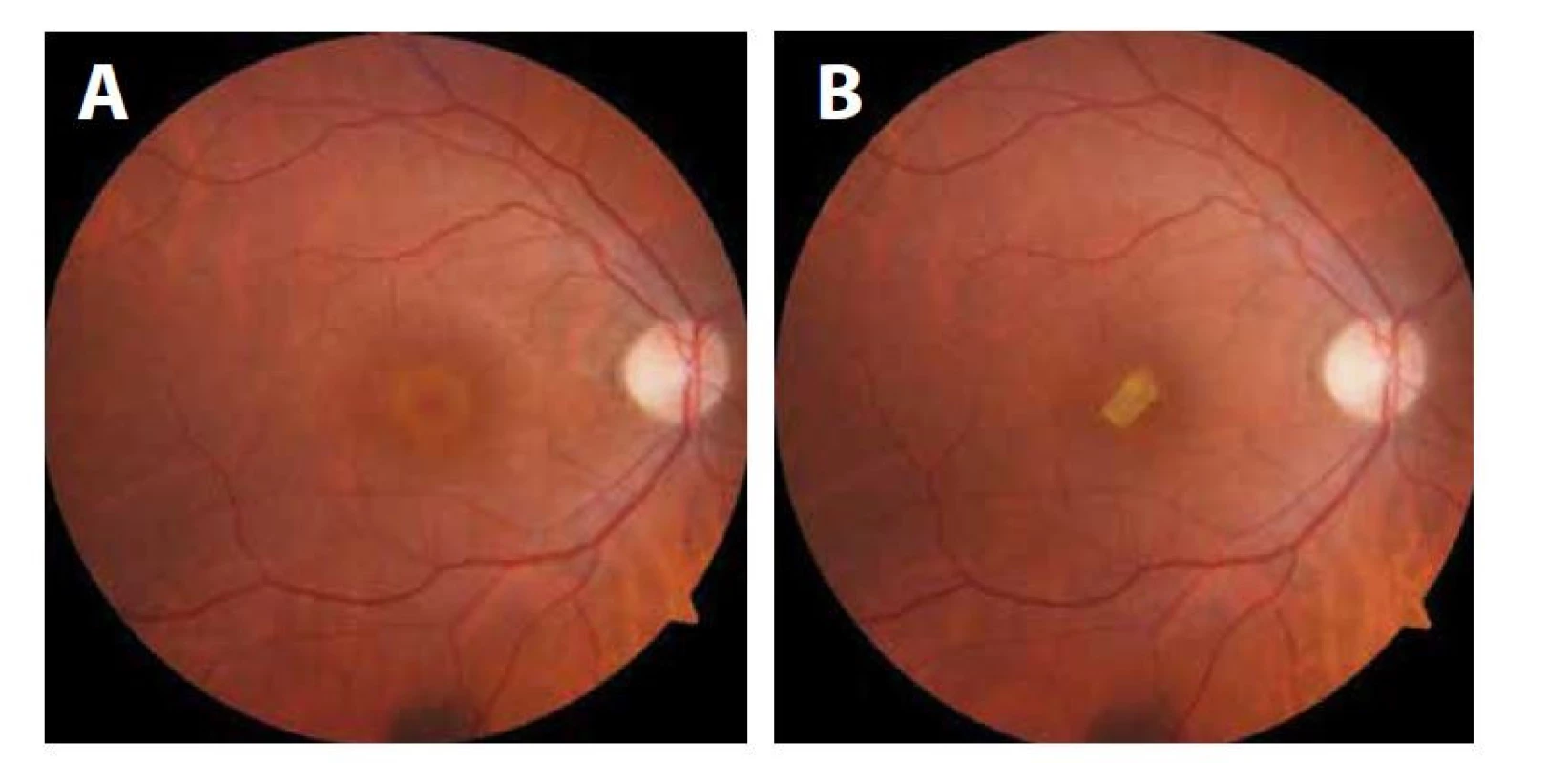 (A) predoperačný nález. (B) pooperačný nález pacientky č. 1, terč zrakového nervu je bledý,
atrofický, pooperačne pretrváva subretinálne zátka z amniovej membrány.
