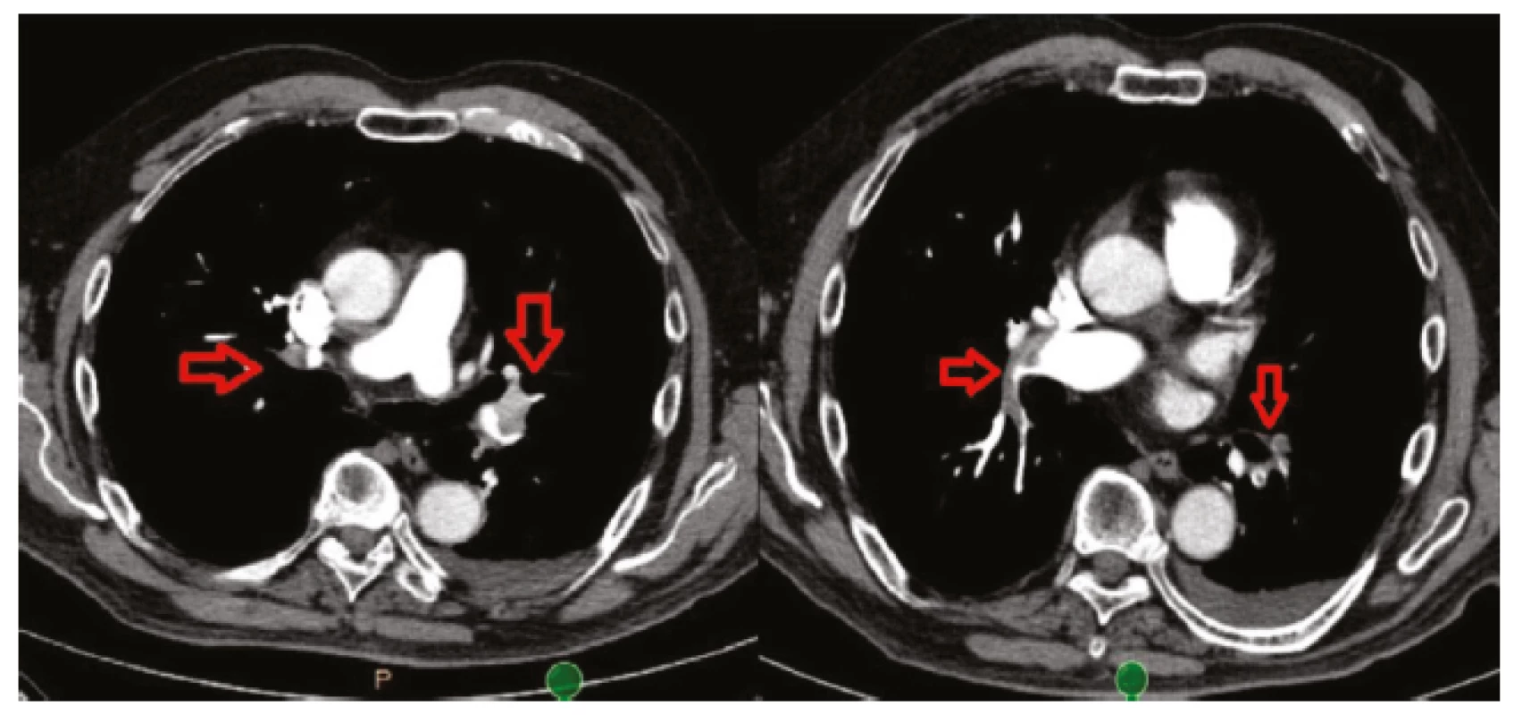 CTAG arteria pulmonalis. Patrna bilaterální masivní plicní embolie v obou
hlavních kmenech plicnice (naznačeno šipkami)