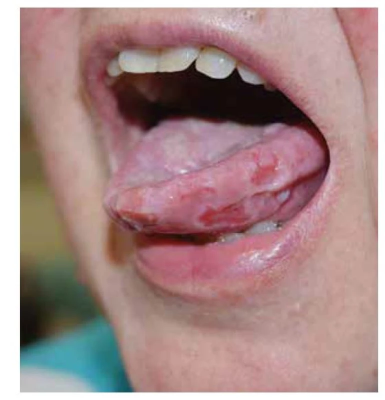 Pemphigus vulgaris, postižení sliznic