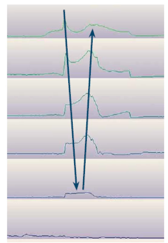 Epizóda supragastrickej eruktácie
počas monitoringu 24hod multikanálovej
intraluminálnej impedancie
s pH-metriou (AccuView). Šípky naznačujú
smer vzostupu impedancie.<br>
Fig. 1. Episode of supragastric belch
on 24-hour multichannel, intraluminal
impedance-pH monitoring (Accu-
View). Arrows indicate direction of impedance
rise.
