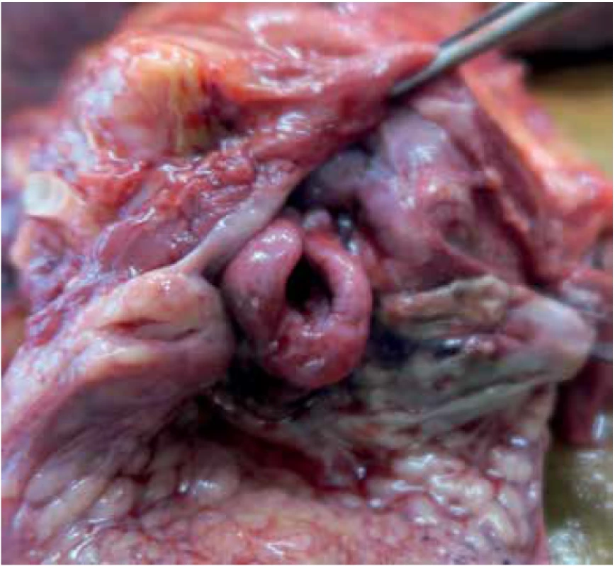 View of the larynx entrance, massive oedema of the epiglottis (before dissection of the cervical complex).