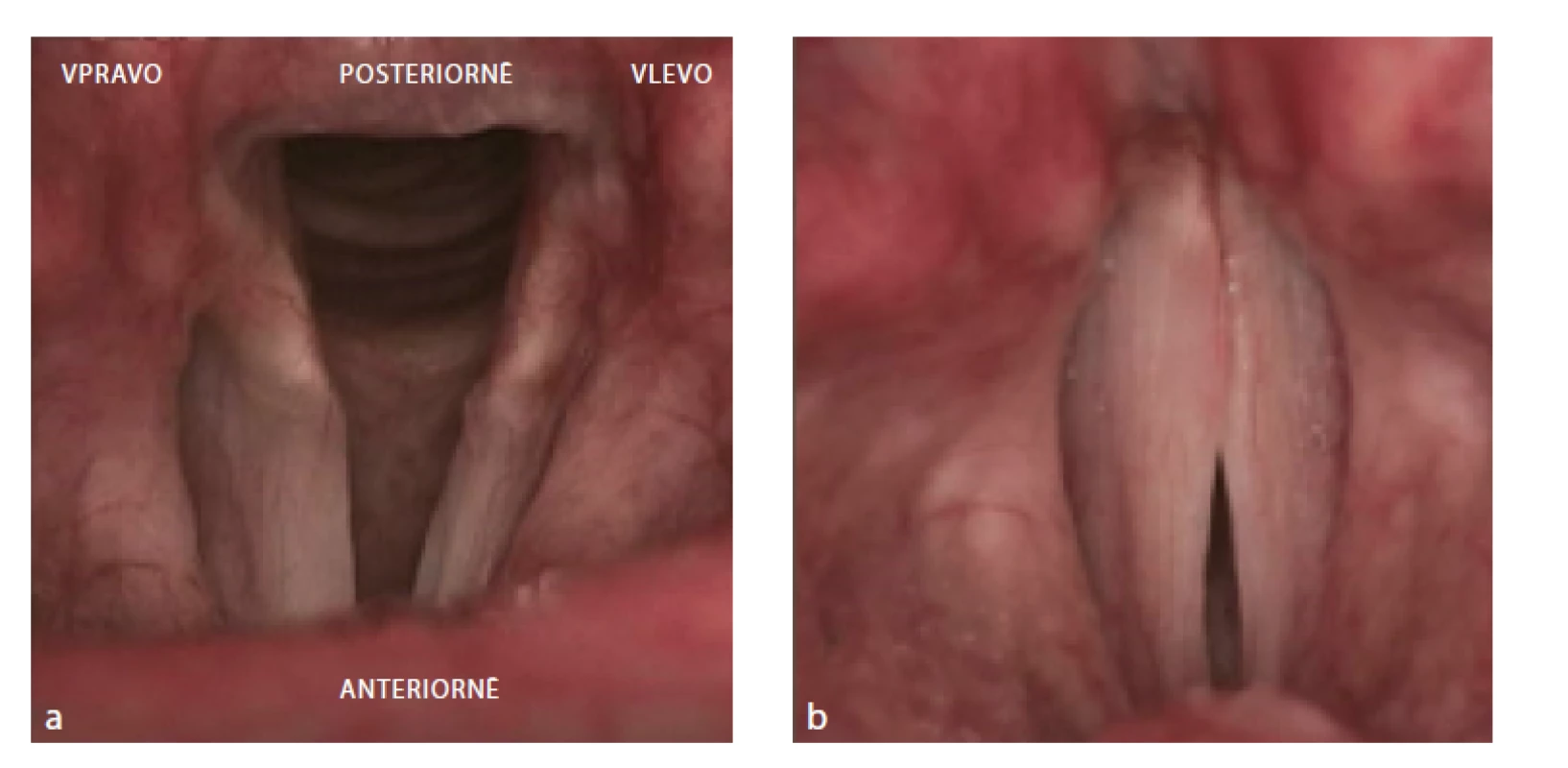 Rigidní lupenlaryngostroboskopie. Inkompletní paréza pravé hlasivky. V respiračním postavení
patrné omezení abdukce vpravo (1a). Ve fonačním postavení insuficience v přední a střední třetině
glottis (1b). Zdroj: Klinika otorinolaryngologie a chirurgie hlavy a krku FNHK