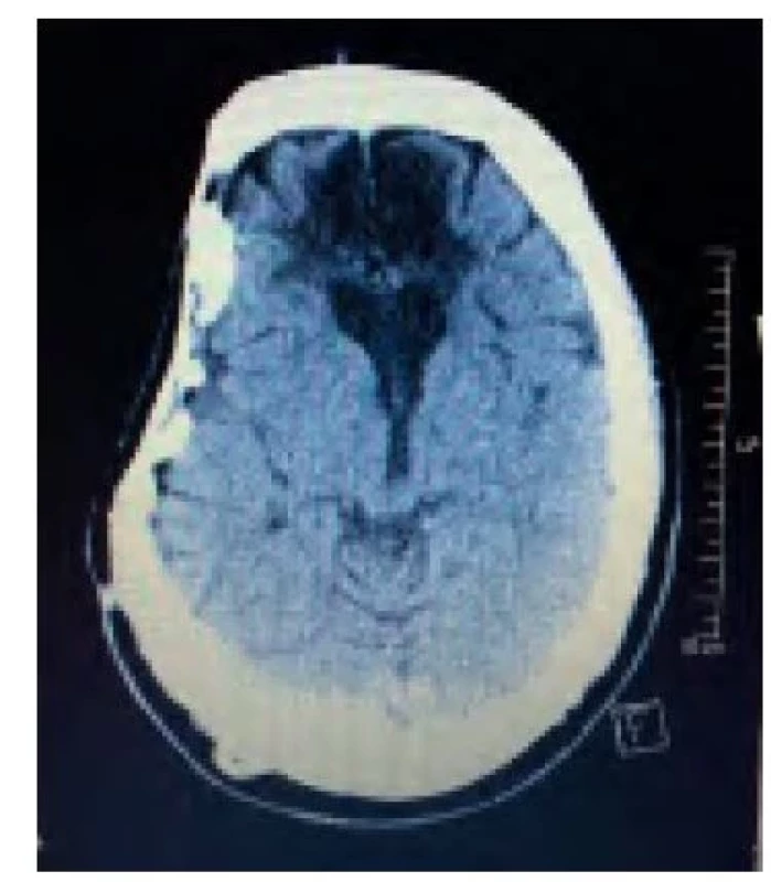 CT mozku po 8 letech od úrazu
– v zadní jámě mozeček i kmen bez
ložiskových změn, stratifikace šedé a bílé
hmoty zachována, supratentoriálně postmalatické
změny vpravo frontobazálně
a bilaterálně frontálně v povodí a. cerebri
anterior, středové struktury s přesunem
doleva o 6 mm, komorový systém symetrický,
mírně užší