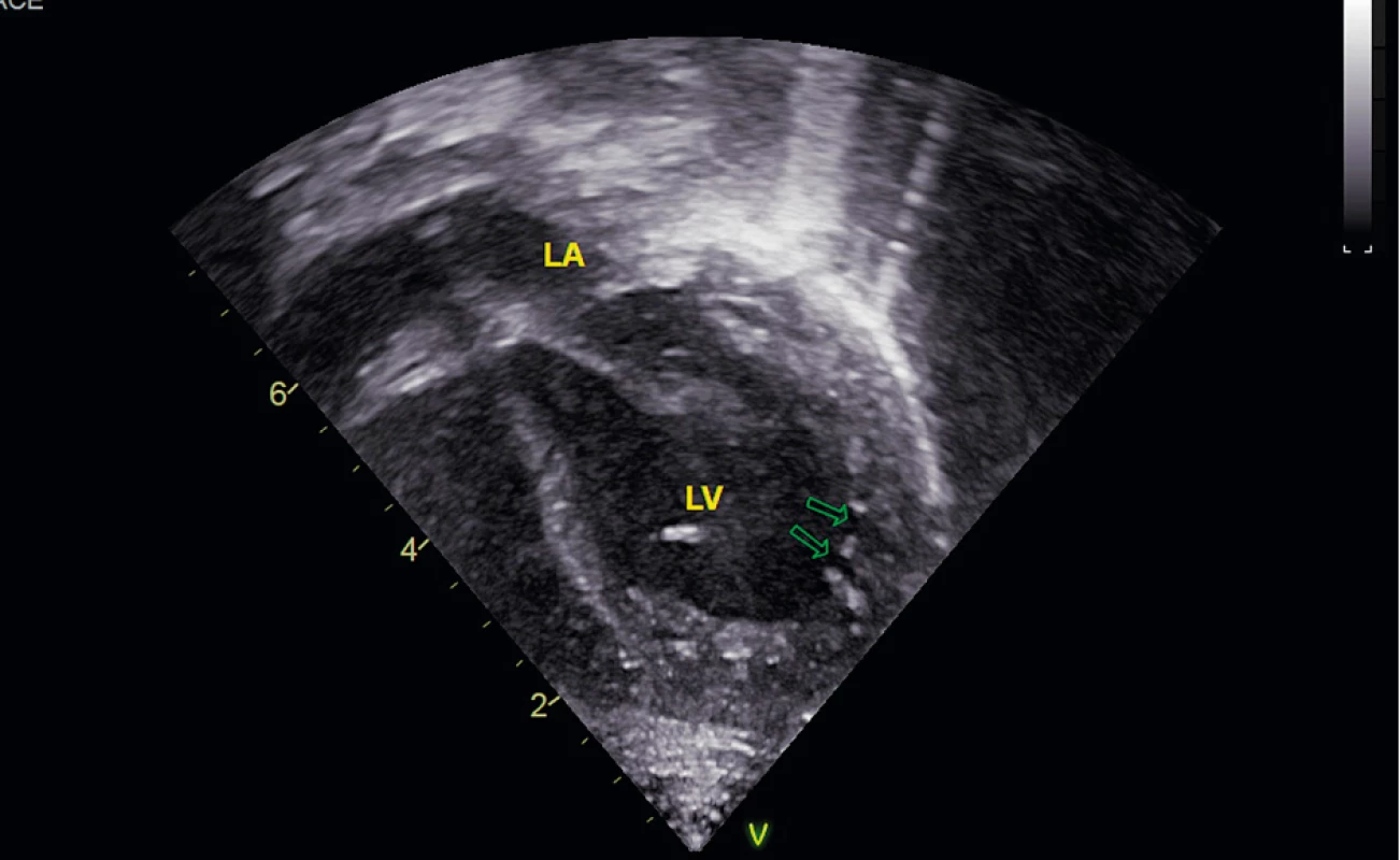 Echokardiogram pacienta s Barthovým syndrómom v apikálnej štvordutinovej projekcii. V ľavej komore v hrote a v laterálnej
stene zobrazené hlboké recesy (označené šípkami) charakteristické pre ľavokomorovú nonkompaktnú kardiomyopatiu
(LA – ľavá predsieň, LV – ľavá komora).<br>
Fig. 1. Echocardiogram of patient with Barth syndrome in apical four-chamber view. In apex and lateral wall of left ventricle
depicted deep recesses (marked with arrows) characteristic of left-ventricular noncompactial cardiomyopathy (LA – left
atrium, LV – left ventricle).