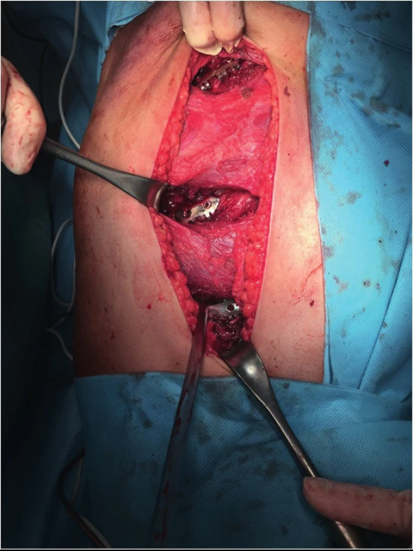 Sparing dissection of muscles for rib splint application, limiting
postoperative soreness