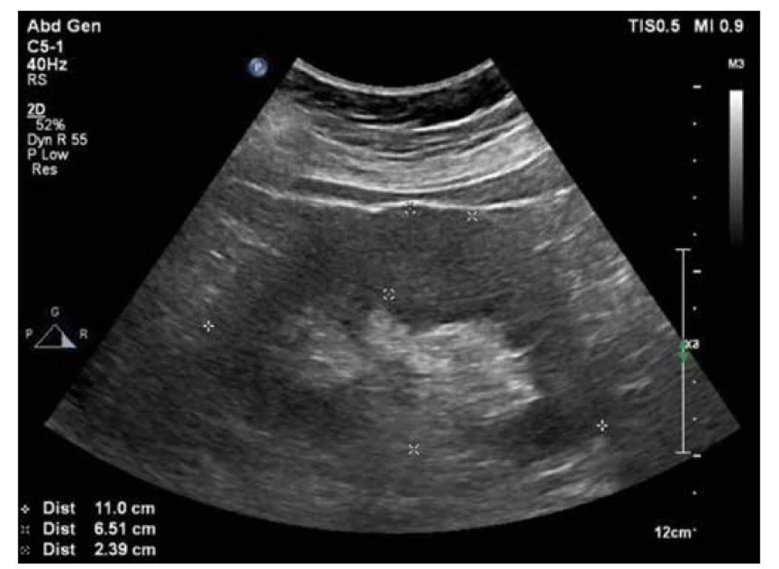 UZ ledvin – ledviny na hranici nefromegalie, parenchym 24 mm bilat.
