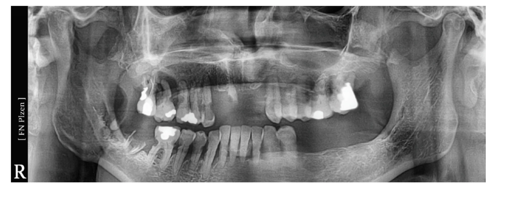 OPG pacienta, kde byly
indikovány všechny přítomné
zuby k extrakci<br>
Fig. 2
OPG of the patient, where all
teeth present were iniciated
for extraction