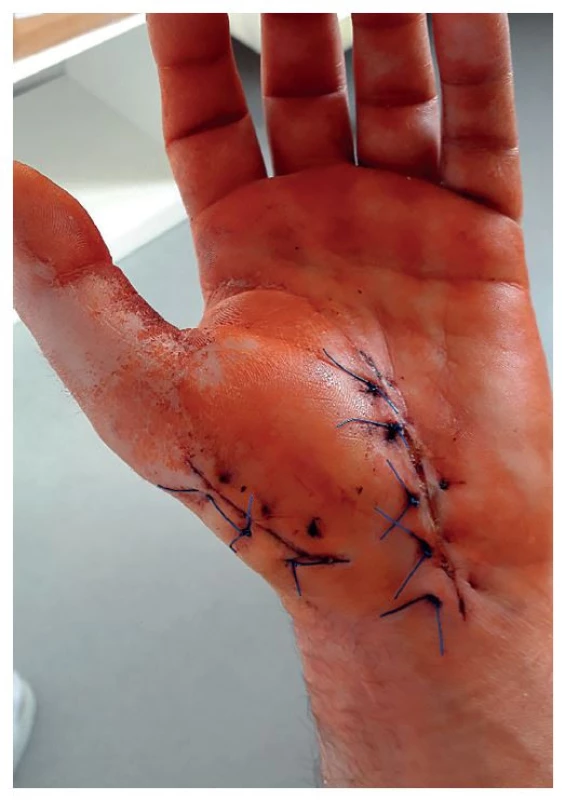 Levá ruka, 8. pooperační den<br>
Fig. 7: Left hand, postoperative day 8