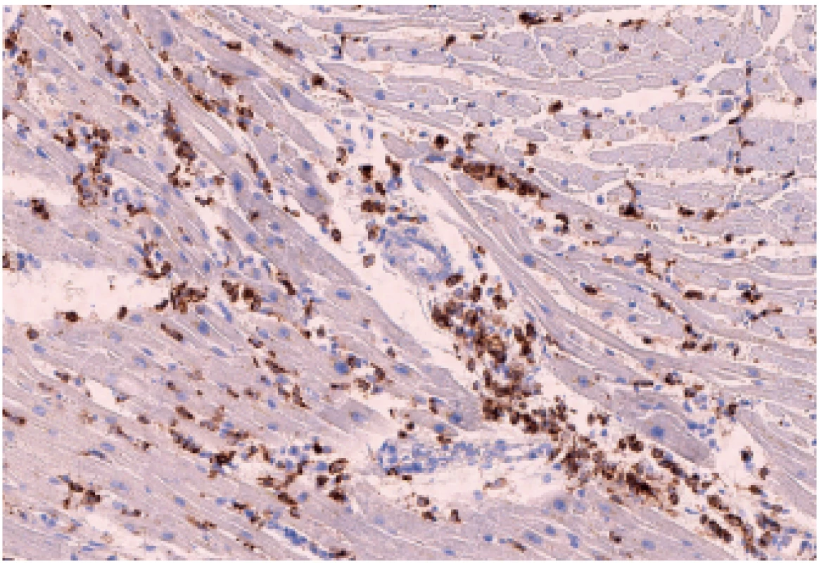 Zánětlivá celulizace v  myokardu pravé komory - histiocyty (CD68,
150x).