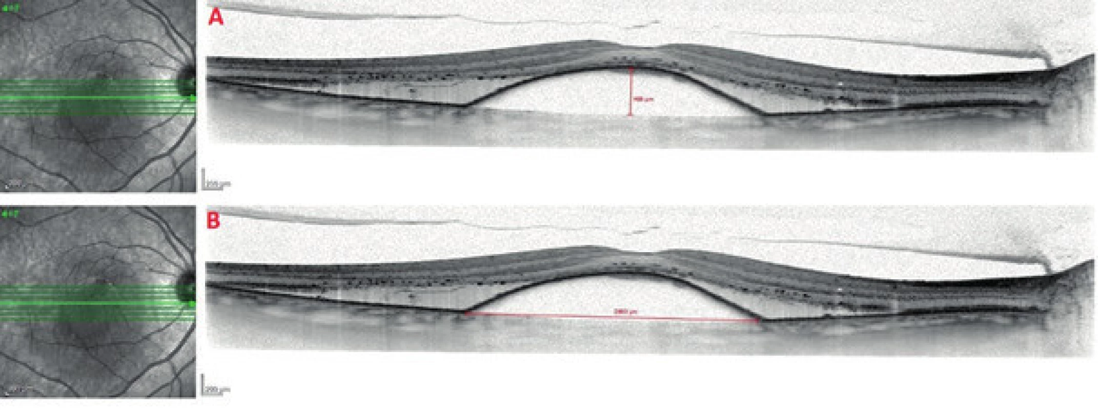 SD-OCT image of vascular serous detachment of retinal pigment epithelium upon a background of occult choroidal neovascularisation<br>
A. Method of measurement of height of RPE detachment<br>
B. Method of measurement of width of RPE detachment