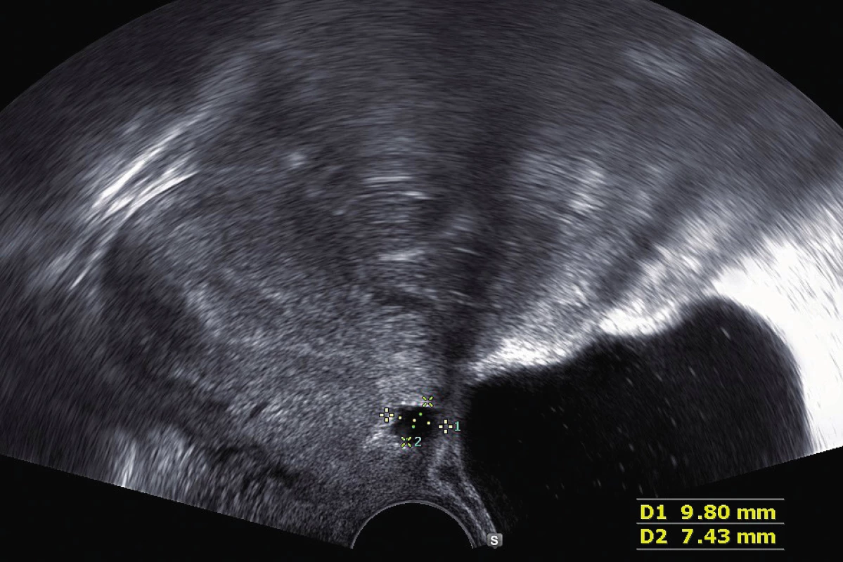 Ultrazvukové vyšetření před operací
