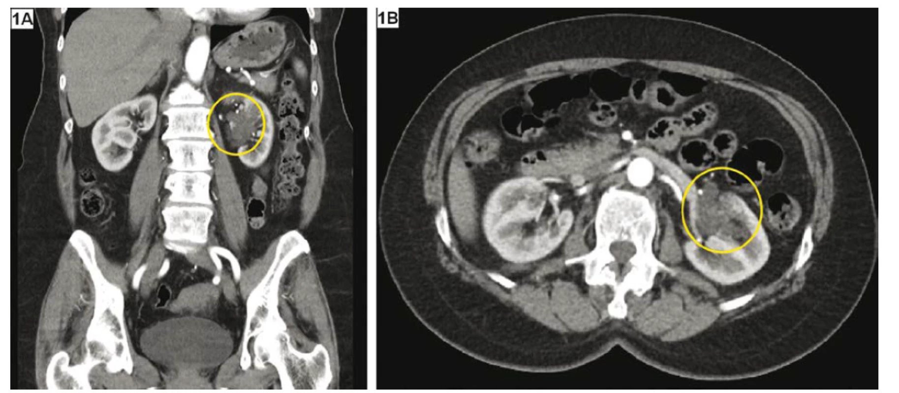 CT zobrazení cystické léze – Bosniak IIF–III; komplex septovaných cyst v levé ledvině; A – koronární řez,
B – axiální řez<br>
Fig. 1. CT imaging of cystic renal lesion – Bosniak IIF–III; multicystic cavities in the left kidney; A – coronal section,
B – axial section