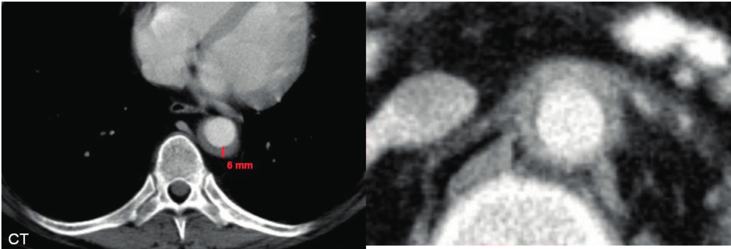 Fibrotické změny u Erdheimovy-Chesterovy nemoci postihují také cévní stěny<br>
Ilustruje to zobrazení aorty se zesílenou cévní stěnou.