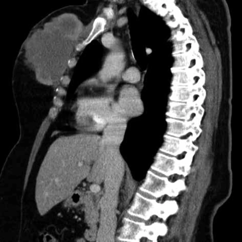 Ambulantní CT scan tumoru pektorální oblasti
Źlutá šipka − sebaceózní karcinom <br>
Fig. 1: Outpatient CT scan of tumor in pectoral area
Yellow arrow − sebaceous carcinoma