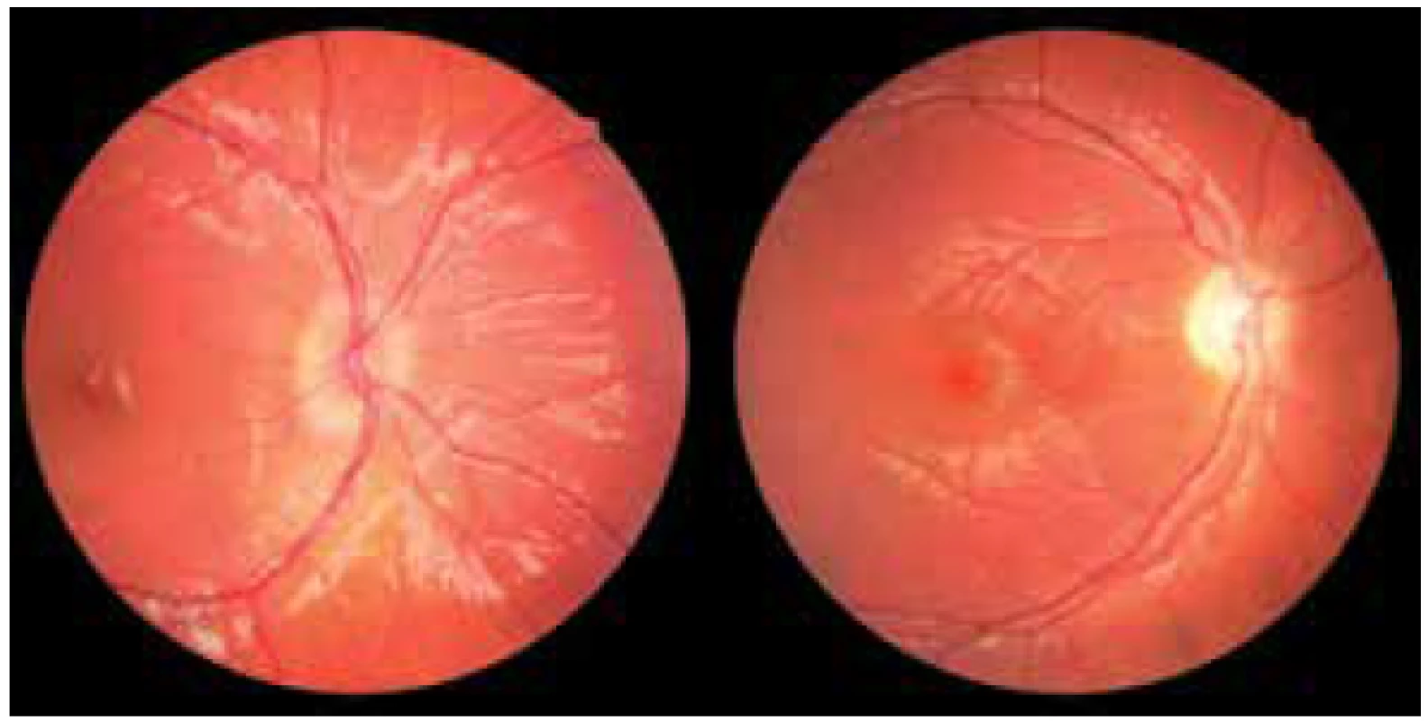 Foto fundu OD: edém papily a atrofie papily
u pacienta s gliomem optiku<br>
Zdroj: Dětská oční klinika LF MU a FN Brno
