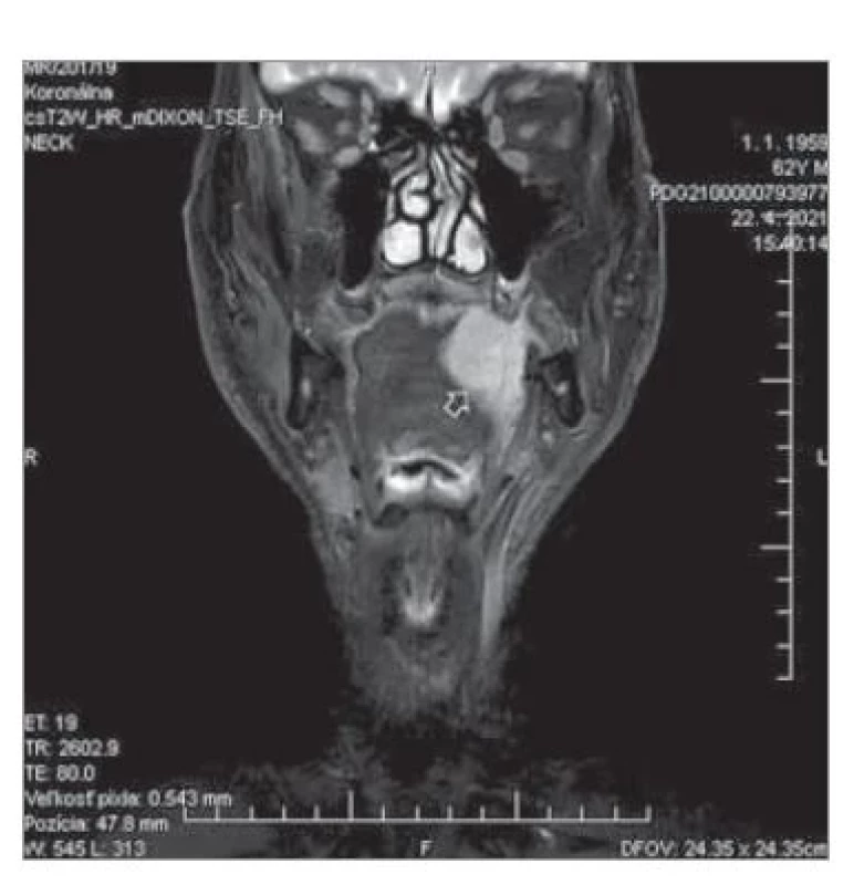 MR pacienta s karcinómom
hrany a tela jazyka vľavo (šípka) indikovaného
na CTS.<br>
Fig. 2. MRI of the patient with carcinoma
of the tongue margin and body
(arrow) indicated for CTS.