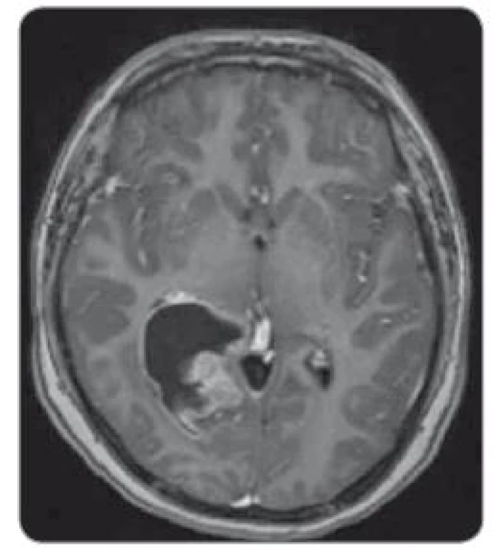 MRI, T1 vážené obrazy s kontrastem
– solidně-cystický tumor supratentoriálně
vpravo v trigonu pravé postranní
komory, sytící se solidní složka.