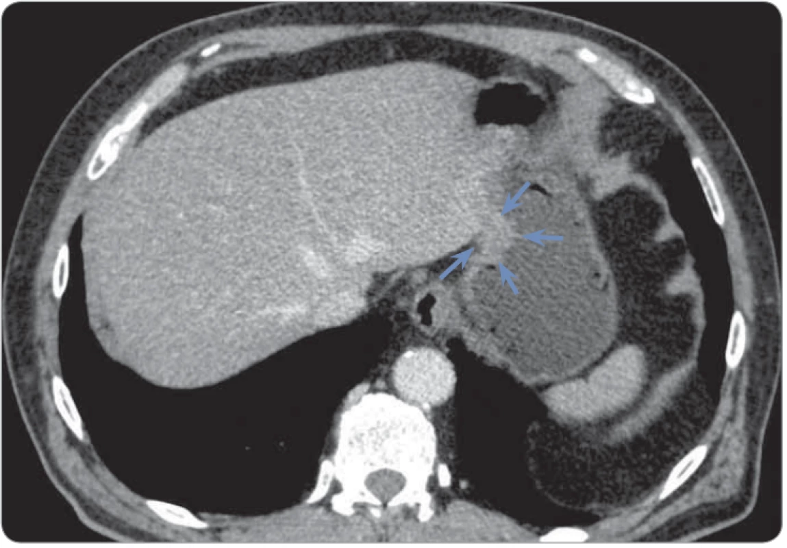 An axial contrast-enhanced CT image at the level of the abdomen shows tumour
of the gastric fundus (blue arrows).