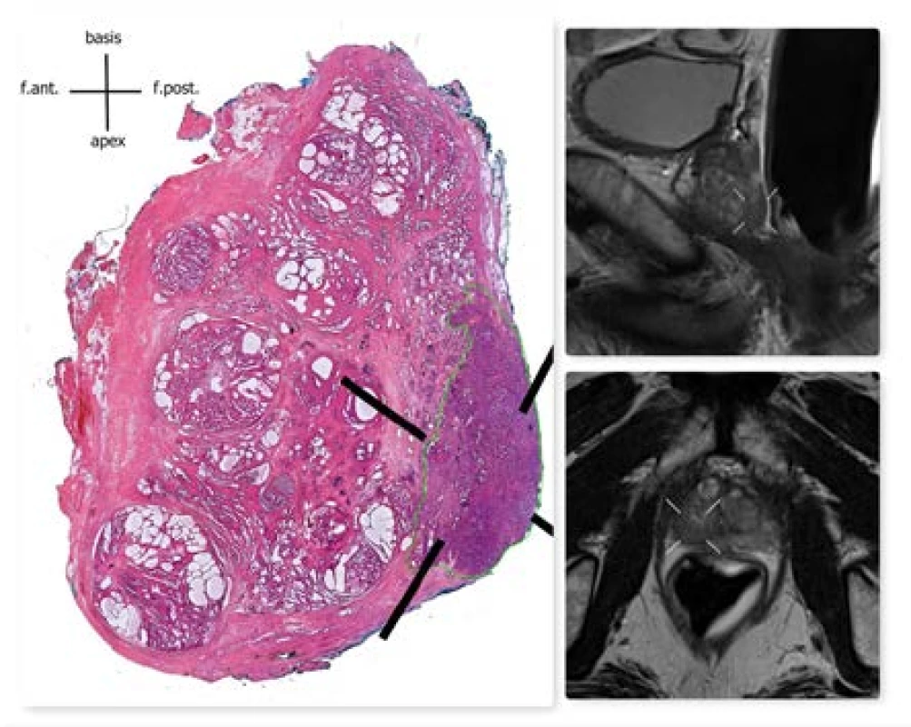 Histologický preparát prostaty (WMS) + sagitální a transverzální MR sken prostaty, šipky vyznačují
nádor<br>
Fig. 6. Histology of prostate tissue (WMS) + sagittal
and transverse MR scan of the prostate, arrows indicating the tumor