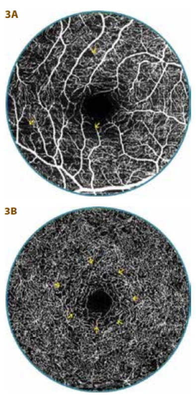 OCT-A examination of 20 year old
diabetic patients (16 year duration of diabetes) with diabetic preretinopathy (DpR)<br>
A. Evident multiple smaller zones of
non-perfusion in superficial vascular
complex (arrows), indication of overlap
of vascular capillary nodes into foveal
avascular zone (FAZ)<br>
B. Capillary network is regular in deep
vascular complex, but slightly thinner
around FAZ (arrows), FAZ surface is wider – 0.37 mm2