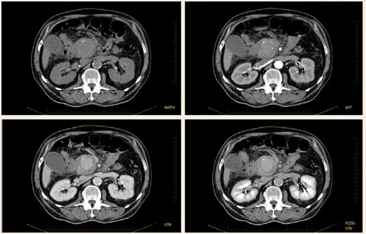 CT vyšetření – pankreatická pseudocysta s maximálním sycením ve venózní fázi.
Fig. 1. CT scan – pancreatic pseudocyst with maximum enhancement in the venous phase.