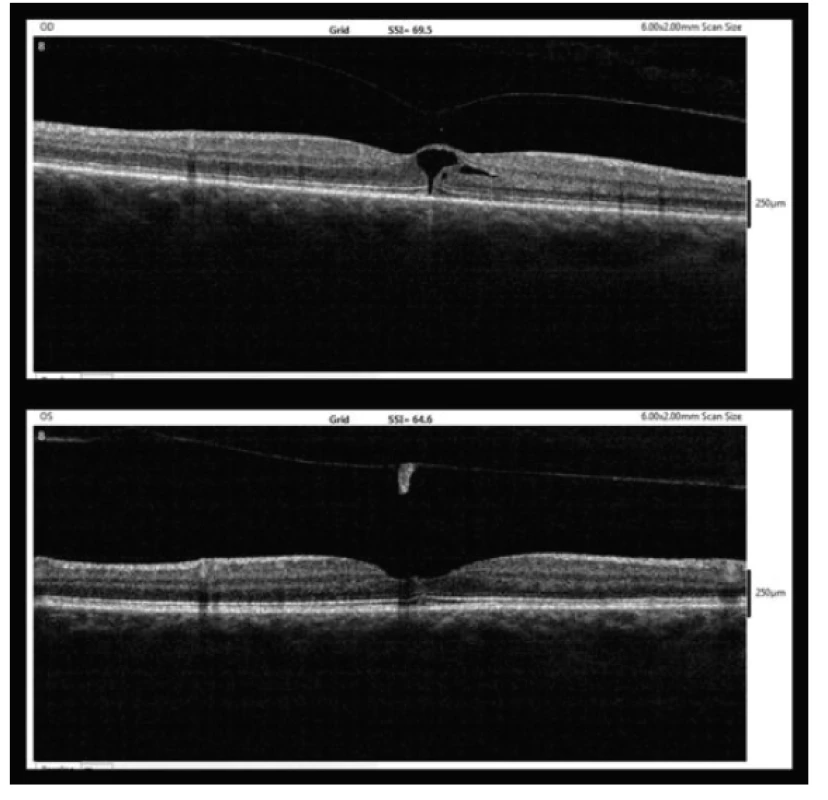 OCT findings five weeks after MH diagnosis (10/2017, upper
– right eye, lower – left eye)