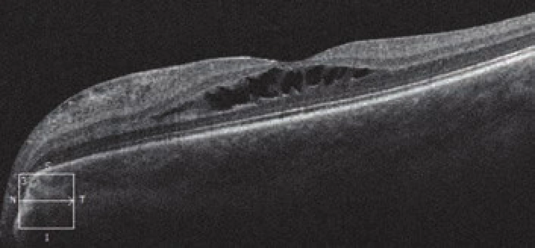 HD-OCT: Linear horizontal transfoveolar scan of left
eye with image of schisis-like maculopathy, with separation
in the region of central retinal layers