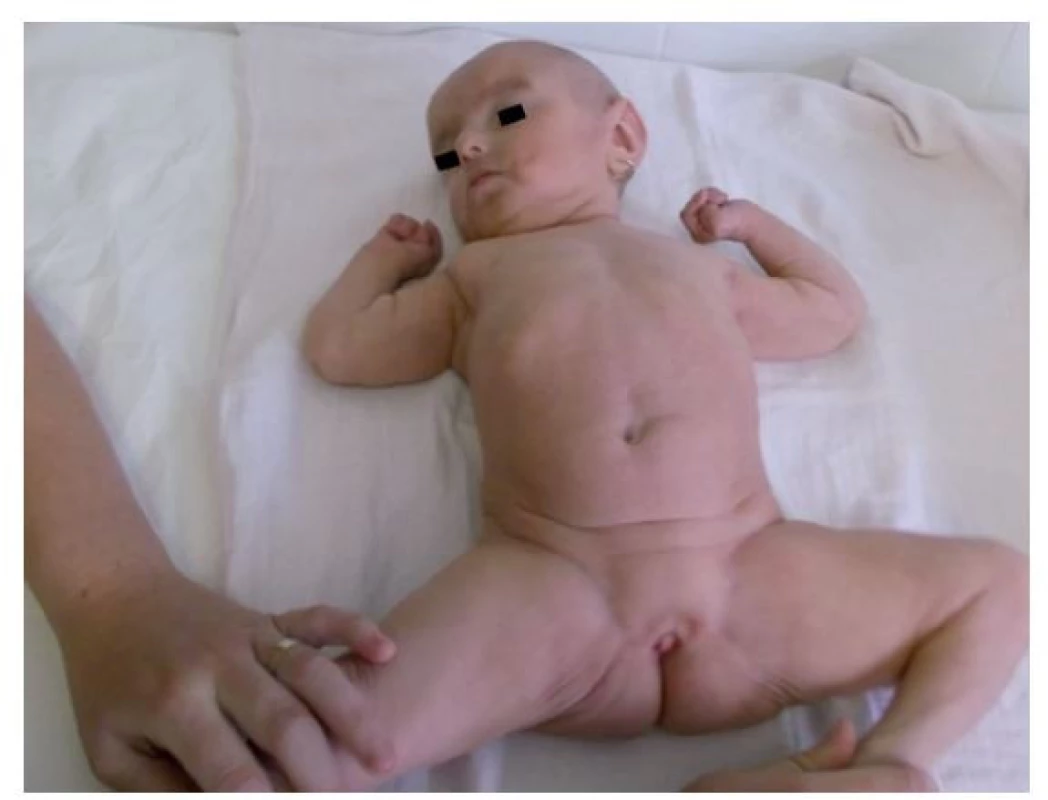 Atypický genitál s výrazne hypoplastickými labia majora
vo veku 17 mesiacov.