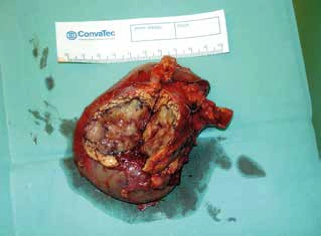 Resekát hlavy pankreatu a duodena se solitární
meta světlobuněčného karcinomu<br>
Fig. 4: Resected section of pancreatic head and duodenum
with a solitary metastasis of clear cell renal carcinoma
