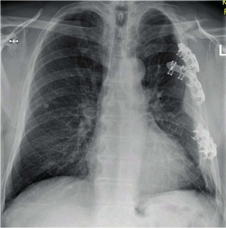 a: Defiguration of the shoulder girdle and hemothorax on the left
in the absence of treatment of the clavicular fracture, accompanying
multiple rib fractures. The patient suffers from severe movement limitation of the upper limb