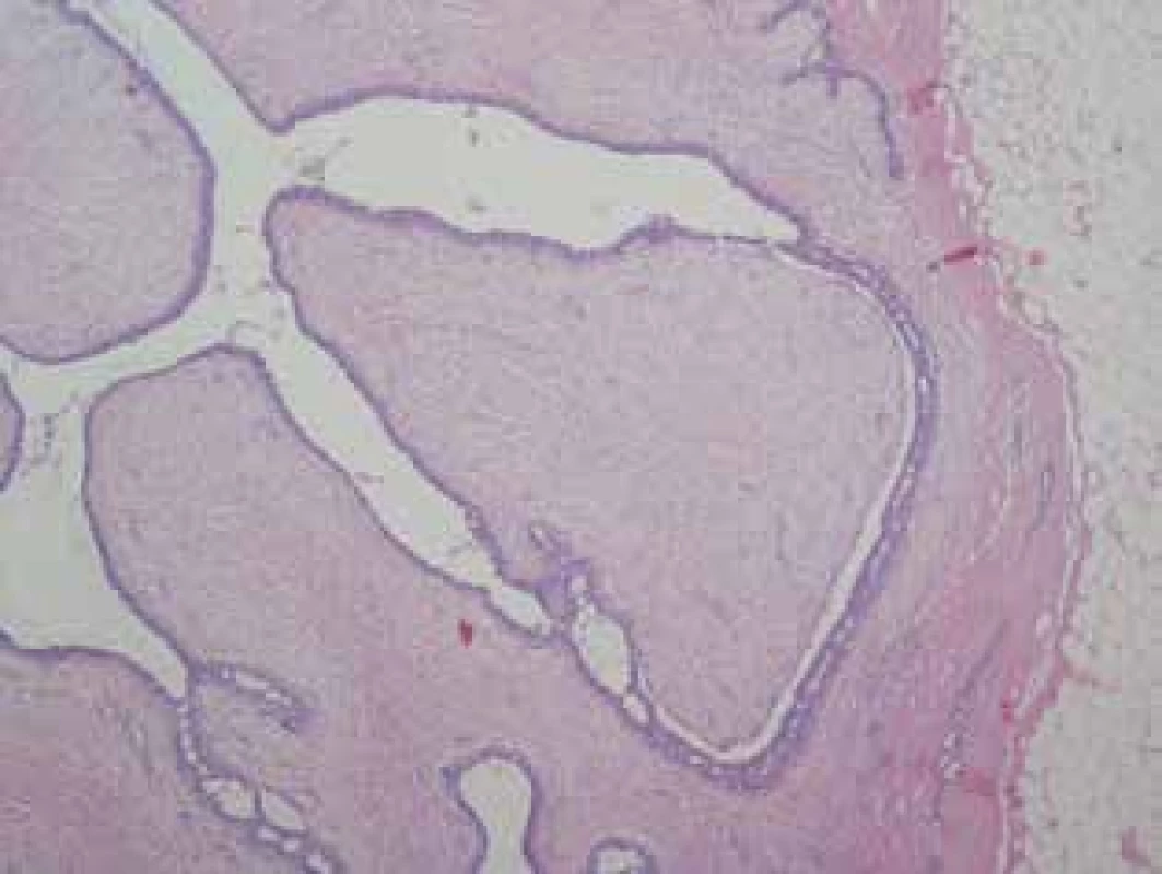 Benígny fyloidný nádor - lístkový charakter nádoru.
(HE, orig. zväčšenie 40x)<br>
Fig.1. Benign phyllodes tumour - leaf-like structure of the
tumour. (HE, orig. magnification 40x)