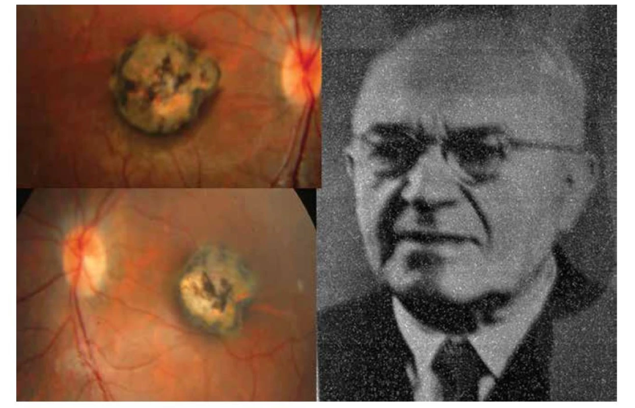 Vrozená forma oční toxoplazmózy v podobě oboustranné makulární jizvy – vpravo. Prof. MUDr. Josef
Janků (1886–1963) – vlevo