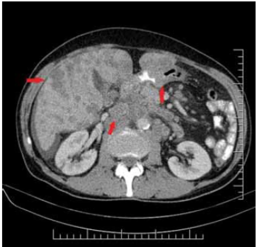 Liver metastases on the right,
centrally-pathologic lymphadenopathy,
on the left tumour of pylorus –
asymetric thickening of the wall.<br>
Obr. 2. Vpravo metastázy heparu, centrálne-
patologická lymfadenopatia,
vľavo tumor pyloru – asymetrické
zhrubnutie steny.
