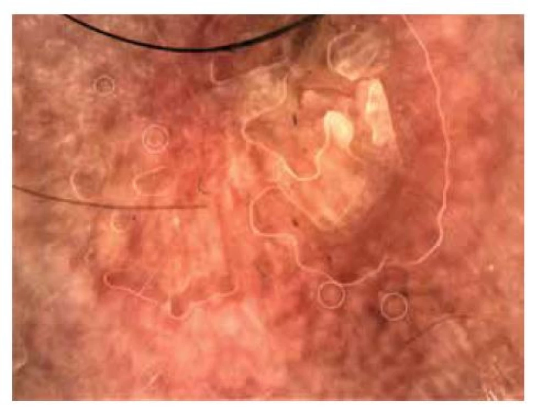 Pacient, 75 let, s mnohočetnými aktinickými keratózami,
nasnímána byla aktinická keratóza z levé spánkové krajiny
s přítomností vícečetných rozet různé velikosti (kroužky)