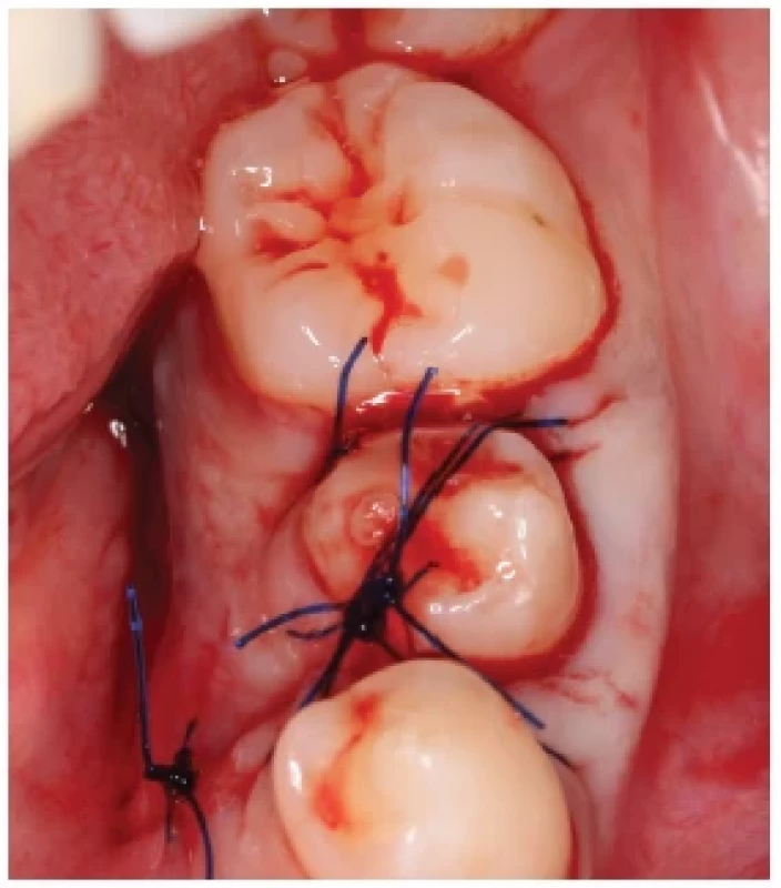 Stav po autotransplantaci
retinovaného premoláru 35. <br> 
Fig. 2.
The status after
autotransplantation
of impacted tooth 35.