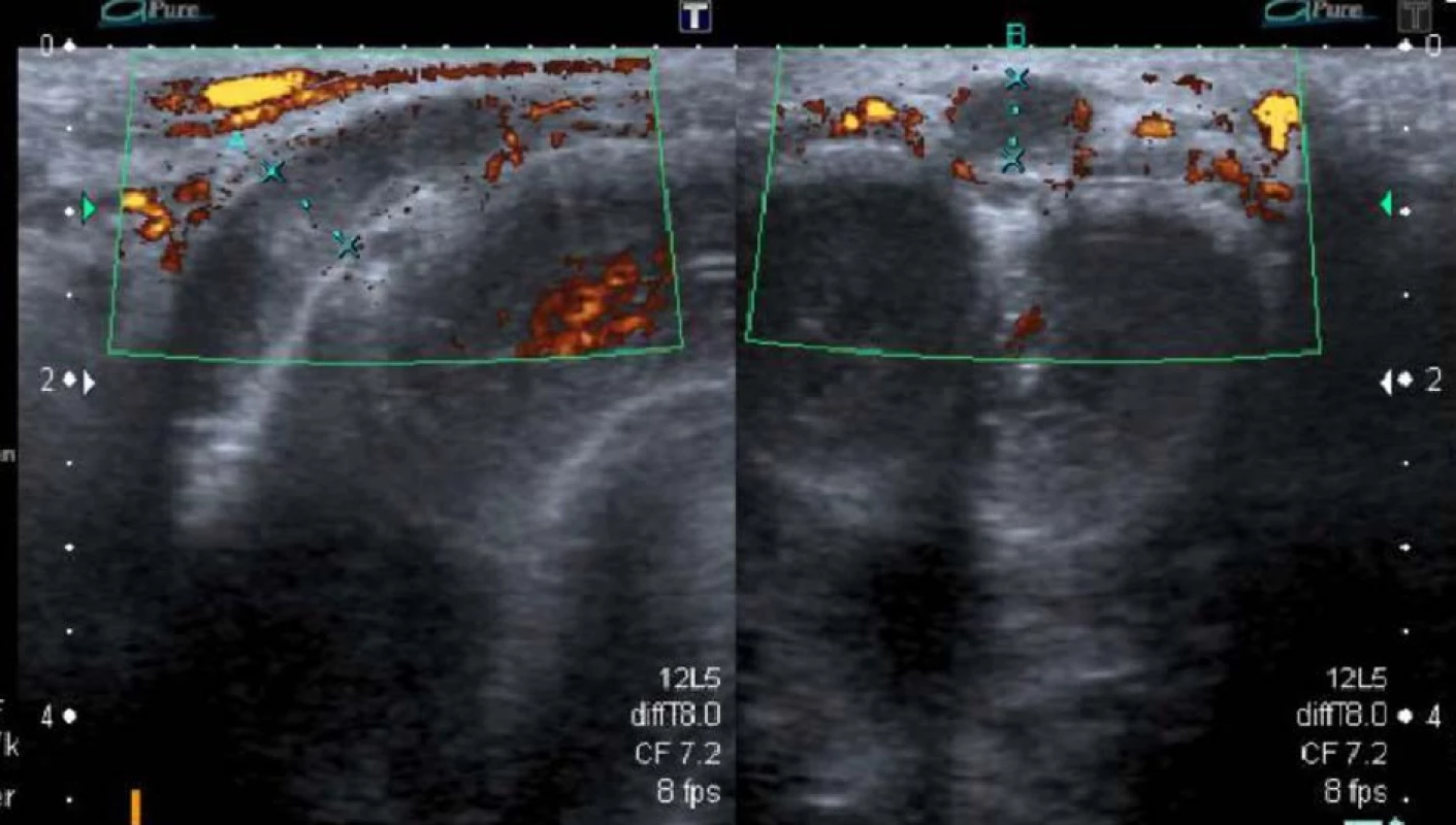Ultrasonografie s užitím barevného dopplerovského vyšetření ukazující trombus a dilataci žíly (archiv autora )<br>
Fig. 2. Color Doppler scan showing the trombus and dilatation of the vein