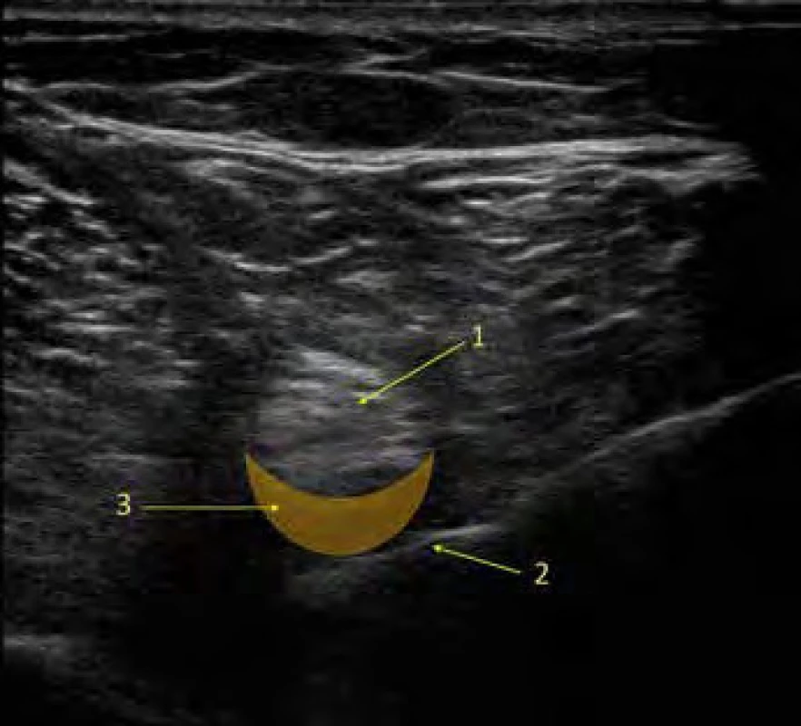Low volume distal sciatic block. Na UZ obrázku ischiadického nervu
je žlutou barvou znázorněna oblast distribuce lokálního anestetika při LVDS
bloku. 1. ischiadický nerv, 2. jehla, 3. oblast distribuce lokálního anestetika.