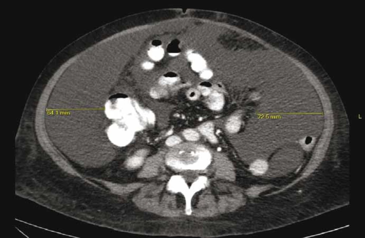 CT břicha – patrné lemy ascitu > 6 cm.