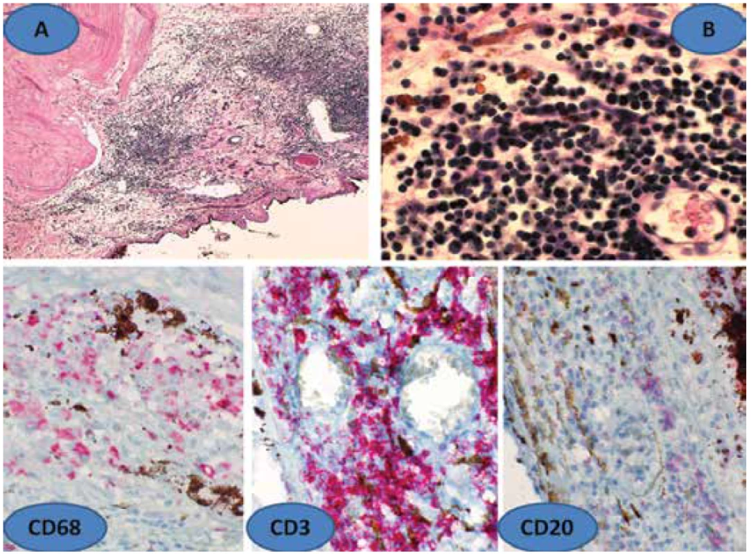 Histologický nález sympatické oftalmie (SO) – zbytnělá uvea s infiltrátem lymfocytů
a makrofágů (A), zvětšení 100x, HE, detail lymfocytárního infiltrátu cévnatky (B), zvětšení
600x, HE. Dole imuno histochemická verifikace SO. Fuchs-Dalenův nodul ohraničený CD68,
dále CD3 a CD20, zvětšení 400x