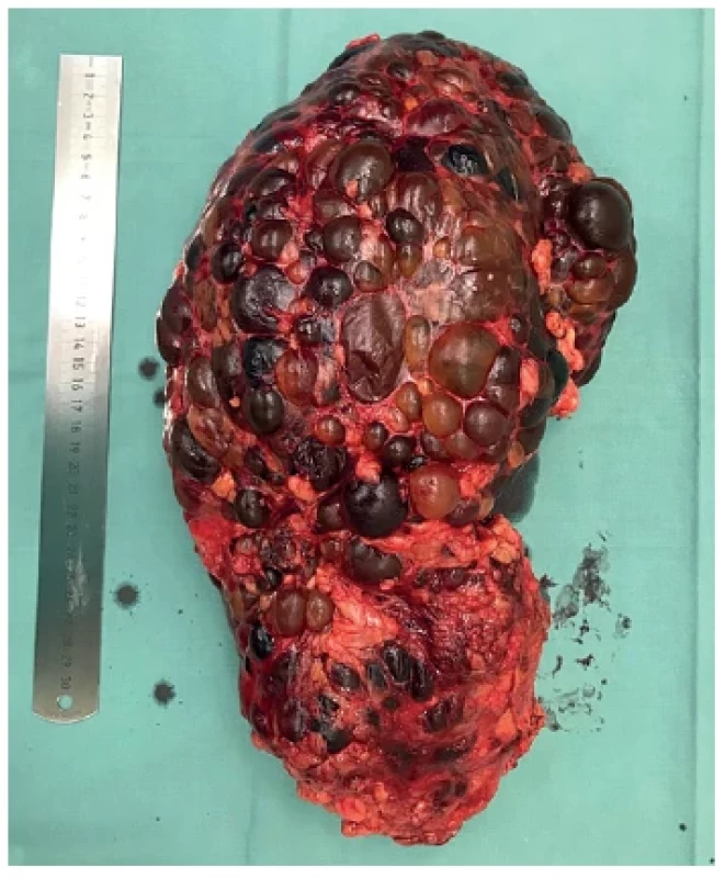 Nefrektomovaná pravá polycystická ledvina, váha
4760 g (zdroj: archiv autora) <br> 
Fig. 1. Native nephrectomy of right polycystic kidney,
weight 4760 g (source: author)