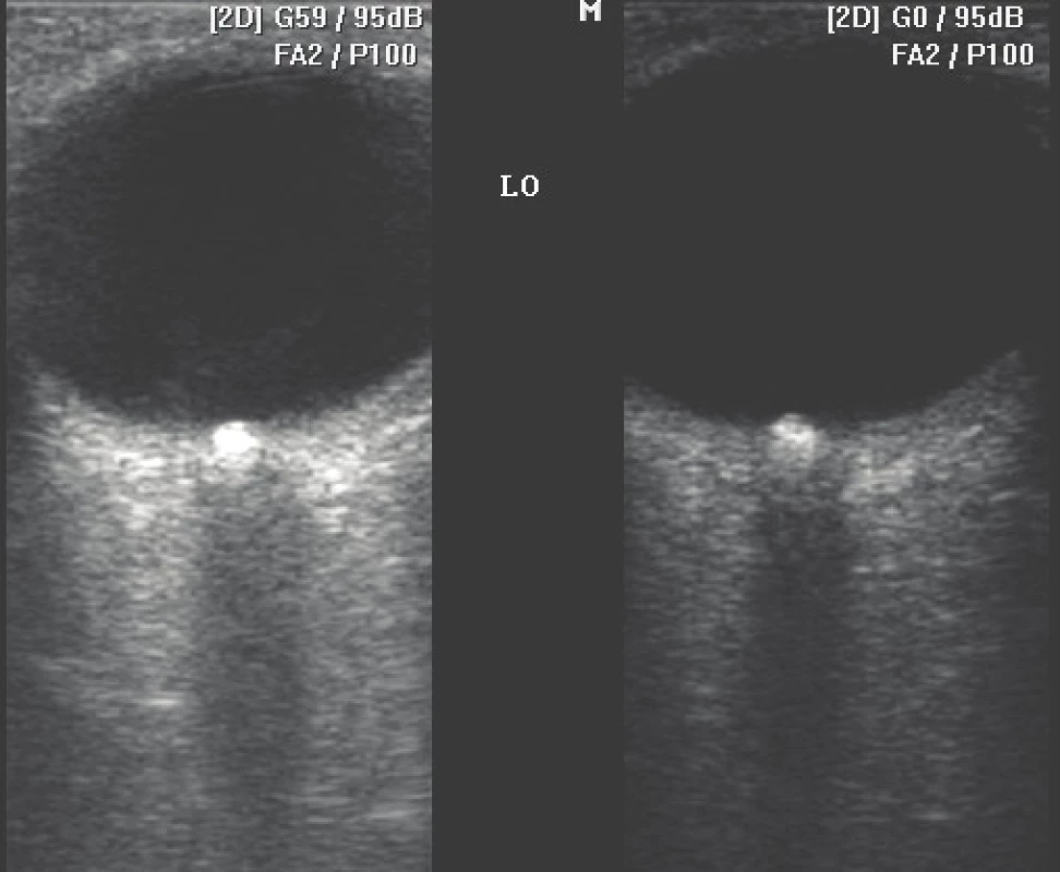 Left: Optic disc drusens B-scan ultrasonography in standard mode – gain
59 dB. Right: “halo” effect of optic disc drusens is minimised (drusens display in
actual size) when gain is reduced to 0 dB.