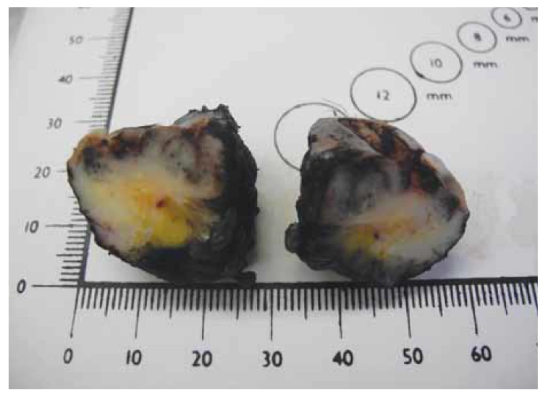 Excize pigmentované léze vulvy.<br>
Fig. 7. Excision of the pigmented vulvar lesion.