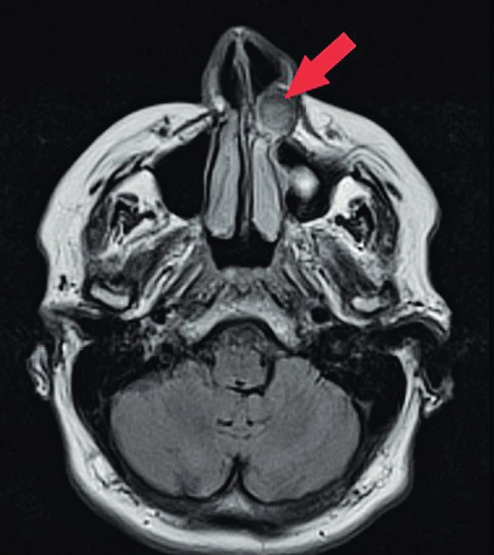 Oválné ostře ohraničené cystické ložisko před přední
stěnou maxily (šipka) vyklenující se do dutiny nosní, MR snímek,
axiální řez