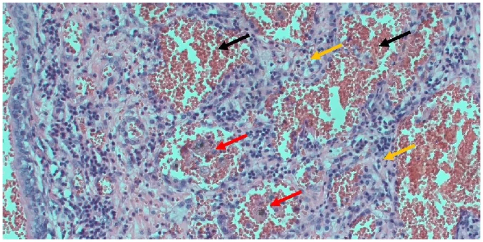 Pohľad na časť pľúc s nálezom hemoragicko hnisavého zápalu so zmnoženým pľúcnym interstíciom (žlté šípky),
s masami kompaktných erytrocytov v lúmene alveolov (čierne šípky) a početnými skupinkami aktinomycét (červené šípky) <br> 
Fig. 3. A view of part of the lung showing hemorrhagic hissing inflammation with increased pulmonary interstitium (yellow
arrows), with masses of compact erythrocytes in the lumen of the alveoli (black arrows) and numerous groups of actinomycetes
(red arrows)