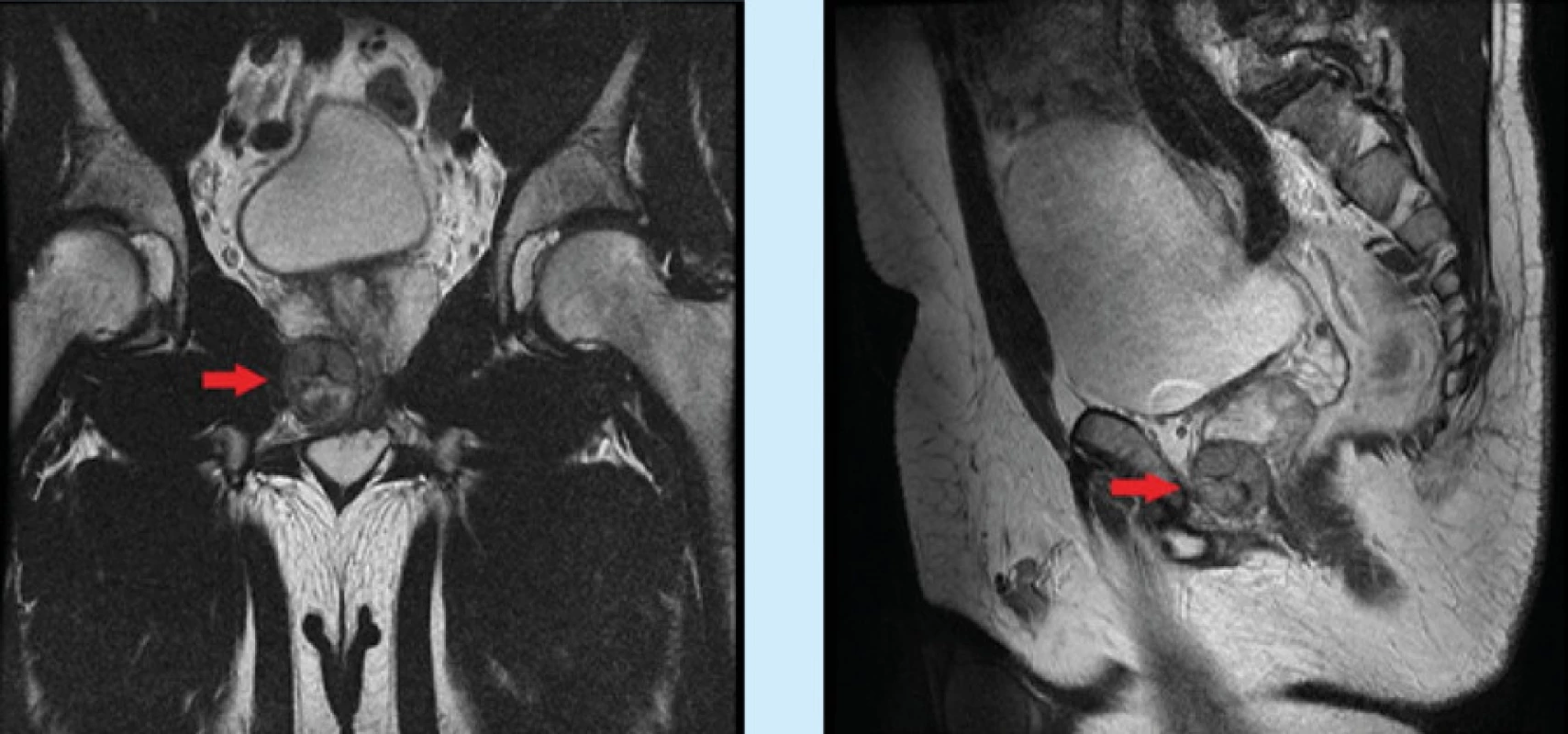 Vpravo při apexu prostaty zobrazeno ložisko velikosti 37 × 31 × 26 mm (obraz MR, vlevo koronární a vpravo
sagitální řez v T2 váženém obraze)<br>
Fig. 1. On the right at the apex of the prostate a lesion measuring 37 × 31 × 26 mm is shown (MR image, on the left
a coronary and on the right a sagittal section in a T2 weighted image)