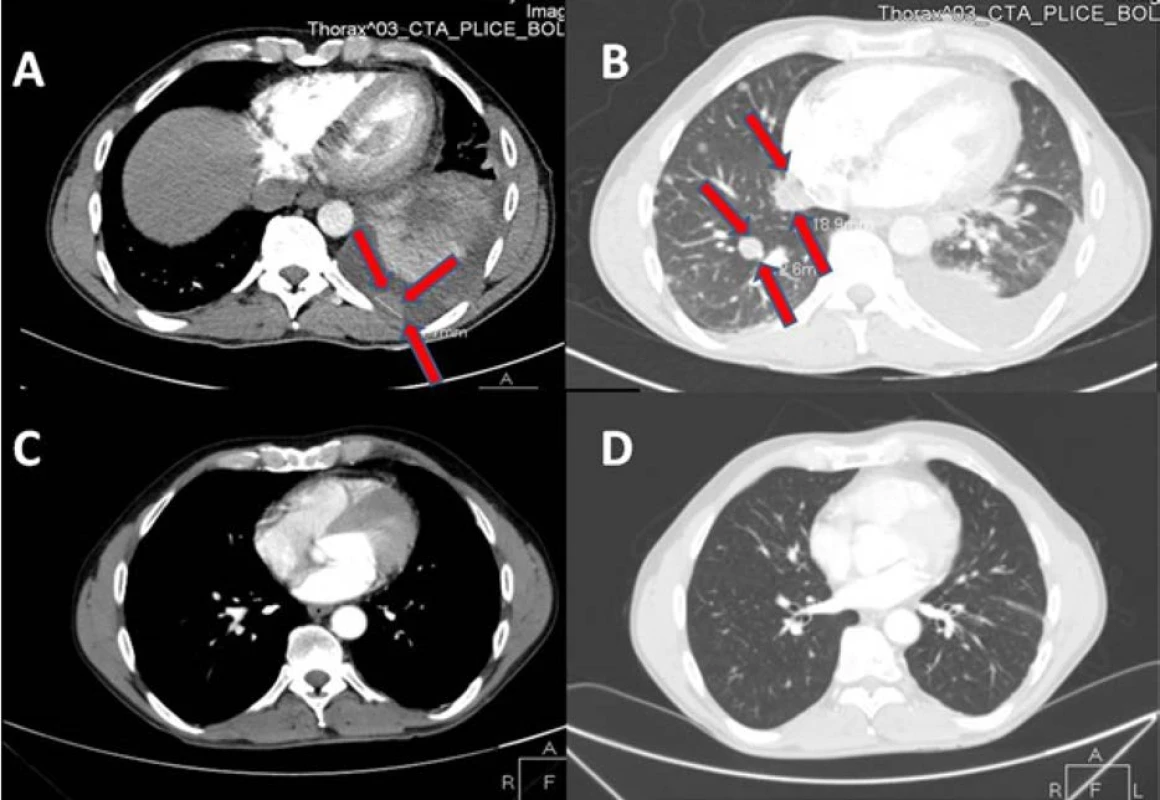 Na vstupním CT vyšetření plic je patrný sytící se tumor pleury (A) s rozsáhlým fluidotoraxem a dvě plicní
metastázy v pravém plicním křídle (B, na kontrolním CT za tři měsíce po léčbě sunitinibem regrese postižení pleury (C) i
plicních ložisek (D); na CT snímcích zobrazeny řezy v přibližně stejné úrovni; ložiska označena šipkami<br>
Fig. 1. Initial CT scan of the lung demonstrates a pleural metastasis (A) with pleural effusion. There are two
metastases in the right lung base (B). CT three months after treatment with sunitinib demonstrates regression of
the pleural (C) and pulmonary metastases (D). Slices at approximately the same level are displayed on CT images.
Metastases indicated by the arrows