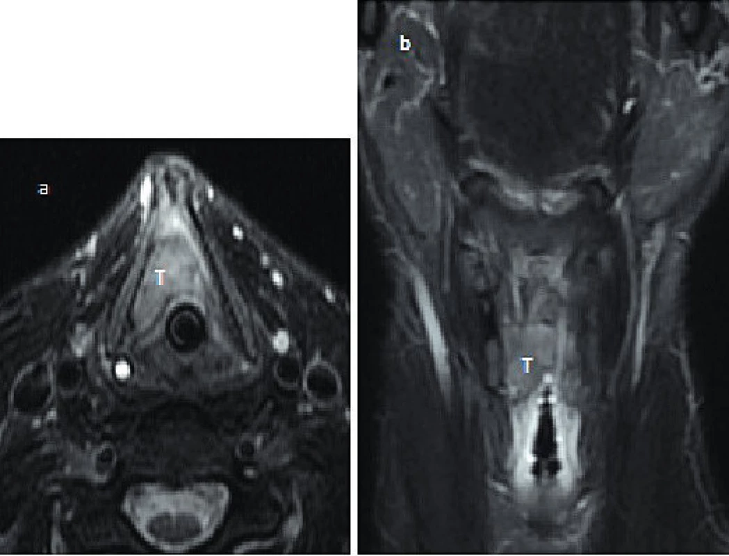 (MRI) a)The larynx b)The larynx - coronary T2 weighted
image with decreases signal-to-noise of fat tissue. The MR images
show tumor mass expansive (T) in the right side of the larynx and
anterior comissure ( no infiltrative growing into thyroid cartilage)
.- axial T2 weighted image with decreases signal-to-noise of fat
tissue.