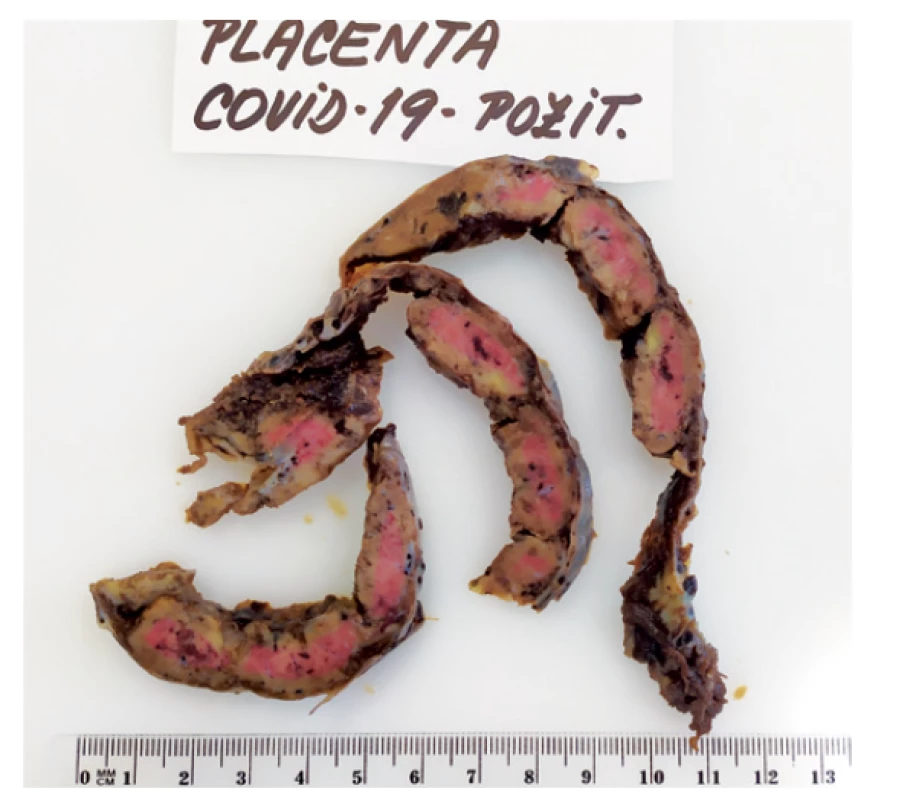 Makroskopická patologie placenty s patrnou signifikantní
abundancí fibrinoidu, postižená je většina placentární
tkáně – placenta výrazně tuhé konzistence